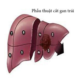 Phẫu-thuật-cắt-gan-trái