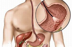 u-carcinoid