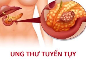 20200923_085514_703401_ung-thu-tuyen-tuy2.max-1800x1800