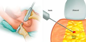 20220608_Sinhthiếtchẩnđoánungthưvúdướihướngdẫncủasiêuâm