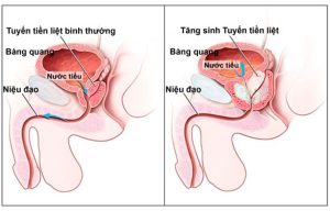 tang-san-tuyen-tien-liet-la-gi