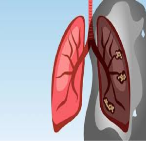 Ung thư phổi giai đoạn 3b