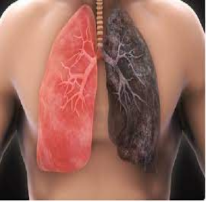 Ung thư phổi ho ra máu sống được bao lâu