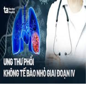 Ung thư phổi không tế bào nhỏ giai đoạn 4