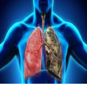 Ung thư phổi sống bao lâu