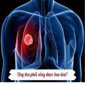 Xạ trị ung thư phổi sống được bao lâu