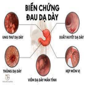 Dấu hiệu ung thư dạ dày giai đoạn 1