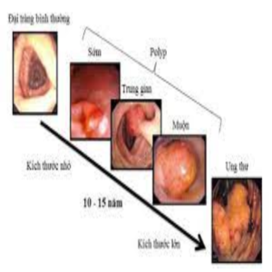 Dấu hiệu ung thư đại tràng giai đoạn 2