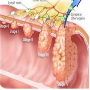 Dấu hiệu ung thư đại tràng giai đoạn 4