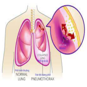 Phổi có nước nguy hiểm không