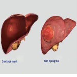 Khối u ở gan có chữa được không