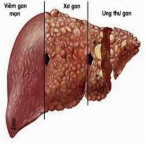 Ung thư gan bị vỡ sống được bao lâu