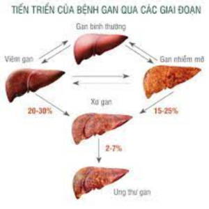 Ung thư gan giai đoạn 3 có chữa được không