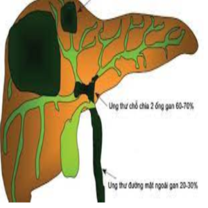 Ung thư biểu mô đường mật trong gan