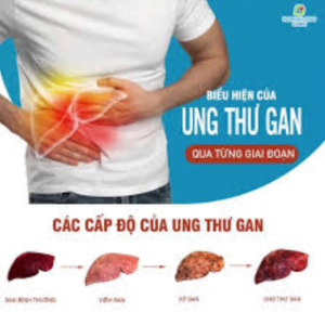 Biểu hiện ung thư gan giai đoạn cuối