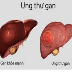 Gan bị ung thư