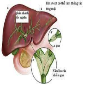 Ung thư đường mật di căn gan