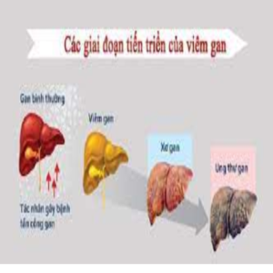 Cách nhận biết ung thư gan