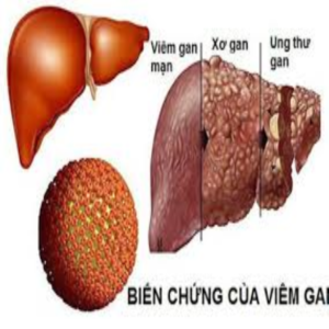 Ung thư gan thời kỳ cuối