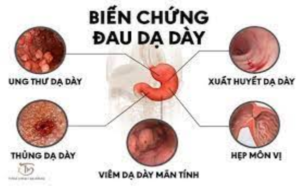 7 dấu hiệu của ung thư dạ dày