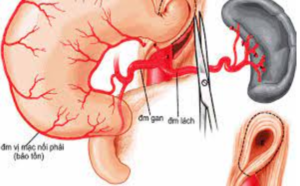 Điều trị ung thư dạ dày giai đoạn 2