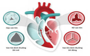 Bệnh tim to có chữa được không