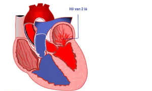 Bệnh tim hở van 2 lá