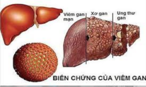 Biểu hiện phổ biến của ung thư gan