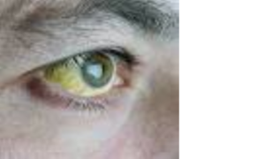Ung thư gan mắt vàng 