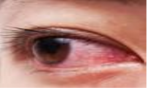 Đau mắt đỏ lây lan như thế nào